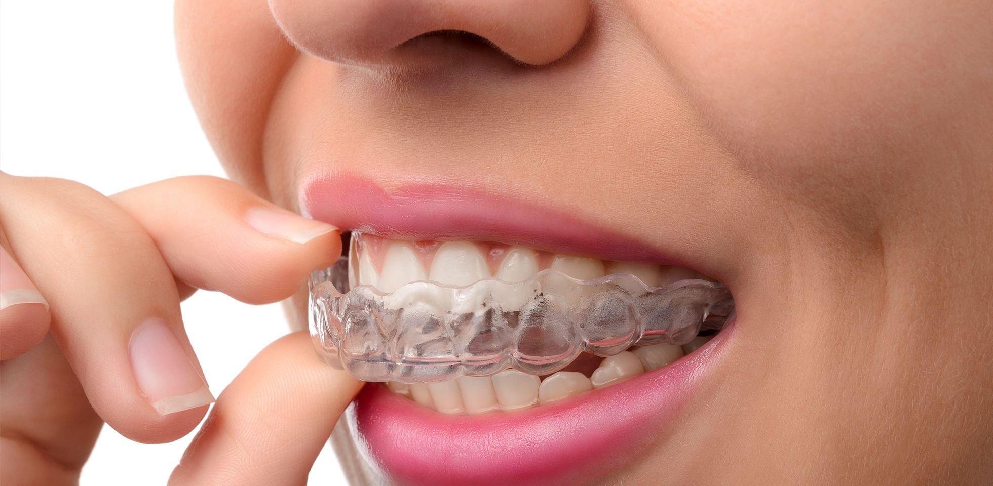 invisalign Monza